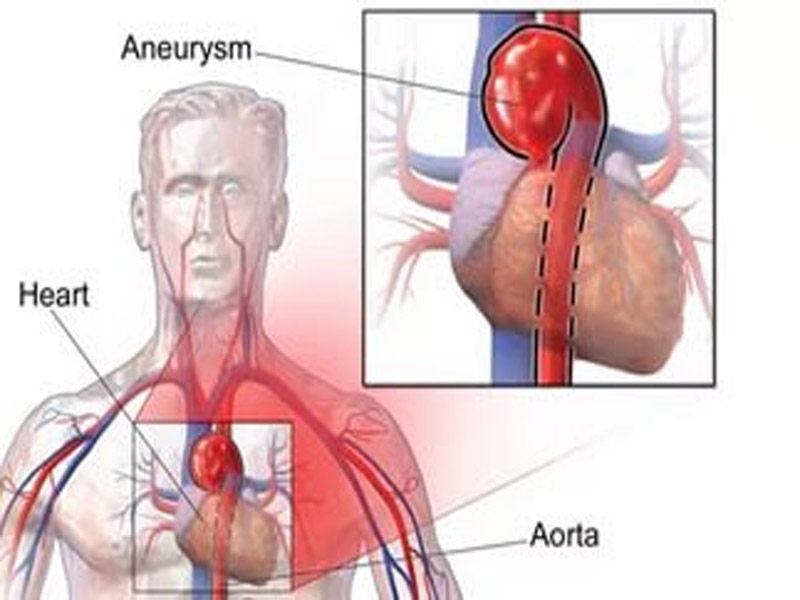 Aort Damarı Nedir Neden Yırtılır Hayatı Tehlikesi Nedir1