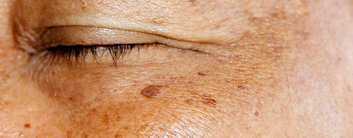 Yaşlılık Lekeleri
