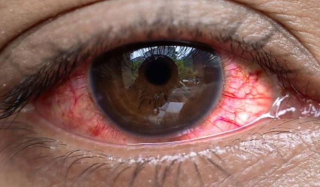 Kırmızı göz hastalığı nedir ve belirtileri nelerdir? Kırmızı göz hastalığının tedavi yöntemleri