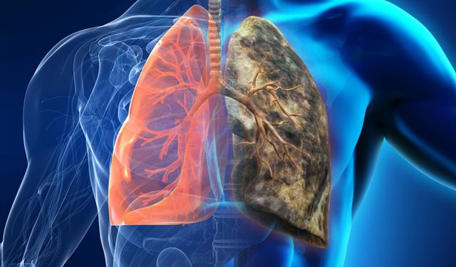 Akciğer kanseri tarih mi oluyor?