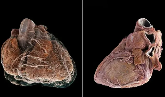 Kalp hastalıklarıyla mücadelede devrim: HiP-CT teknolojisi