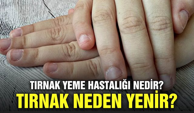 Tırnak yeme hastalığı nedir? Tırnak neden yenir?