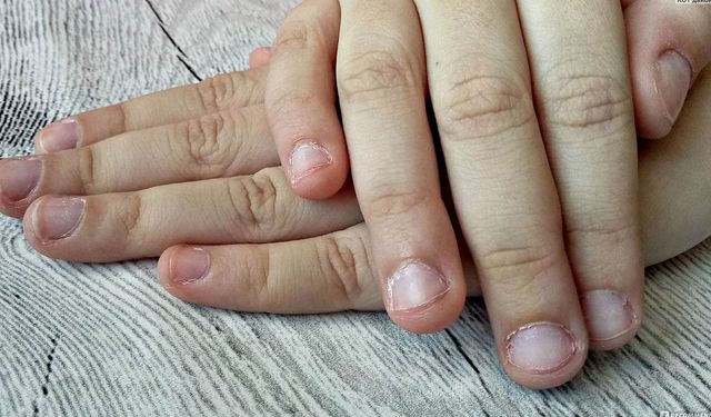 Tırnak yeme hastalığı nedir? Tırnak neden yenir?